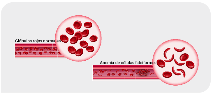 Glóbulos rojos normales vs. anemia falciforme